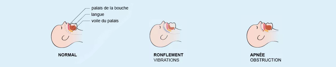 Parcours de l'air en cas de ronflements ou d'apnée du sommeil